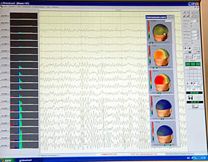 ЭЭГ картирование