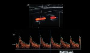 Триплексный режим и автотрассировка спектра в позвоночной артерии. 