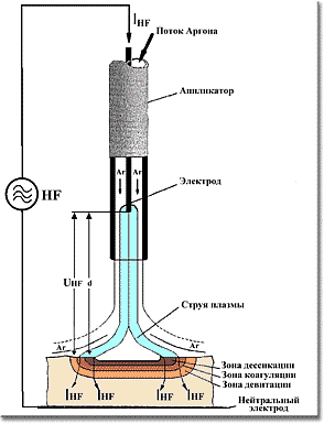 Аргоноплазменный коагулятор Argon 4