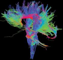 Диффузионно-тензорная визуализация ЗЧМТ